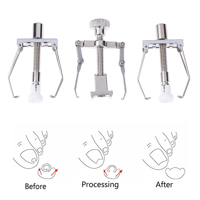 1PCS Ingrown Toenail Correction Tool Nail Corrector Tool Kit Toe Paronychia Nail Brace Pedicure Care Tool