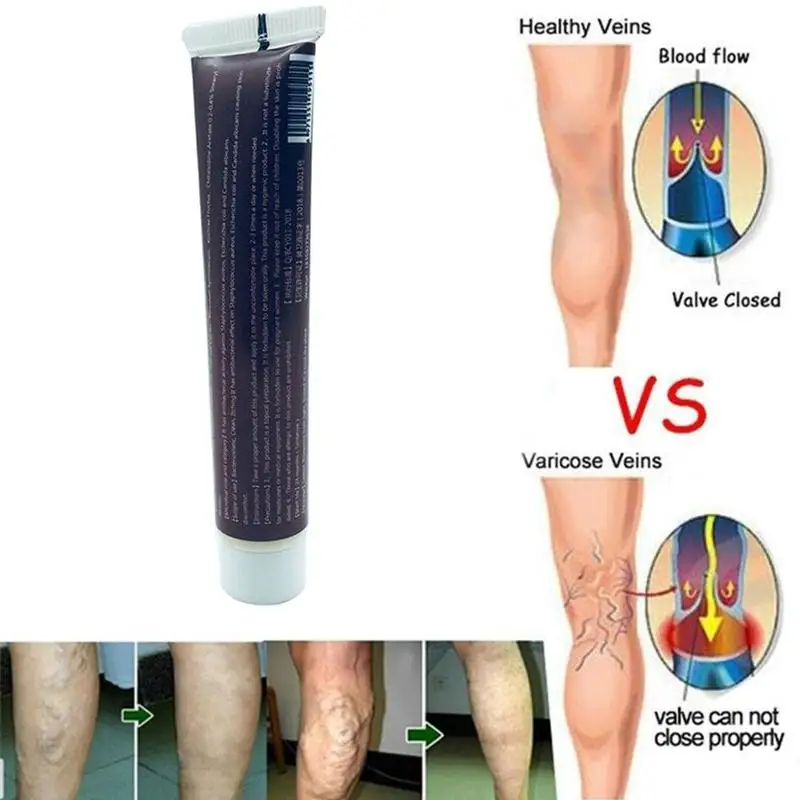 20 г чудо-крем для лечения варикозного расширения вен эффективное лечение васкулита флебита паучьи вены облегчение боли травяная мазь для ангиита
