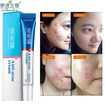 

ISILANDON 20g Acne Treatment Blackhead Remova Anti Acne Cream Oil Control Shrink Pores Acne Scar Remove Face Care Whitening