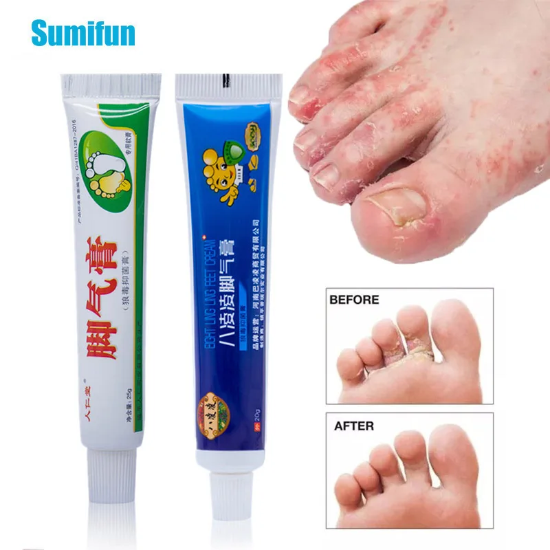 Two Styles Anti Fungal Infections Foot Cream For Athlete's Foot Pain