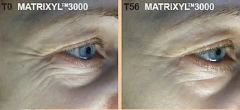

30 ML - Matrixyl 3000 Palmitoyl Oligopeptide Peptide~WRINKLES REDUCE TREATMENT~