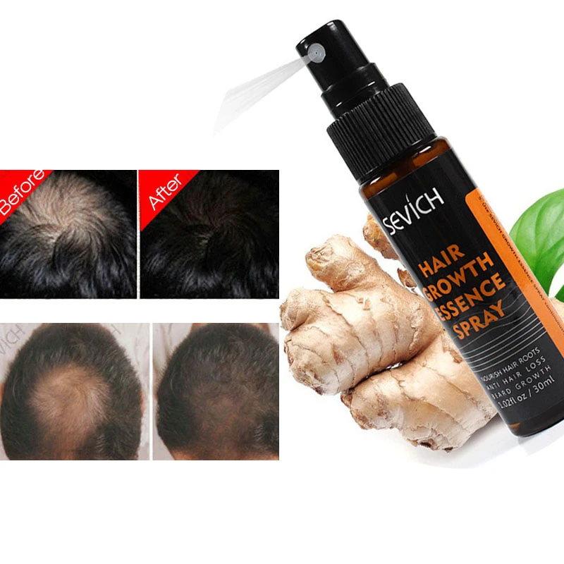 30ML essenze per la ricrescita dei capelli riparazione Spray cuoio  capelluto trucioli dei capelli prevenire la