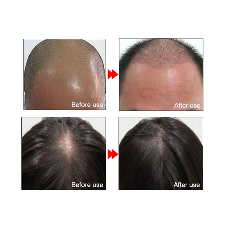 Эфирное масло для роста волос против выпадения волос Liquid Hair Repair Treat men t Dense men Regrowth Сыворотка для ухода за волосами 20 мл