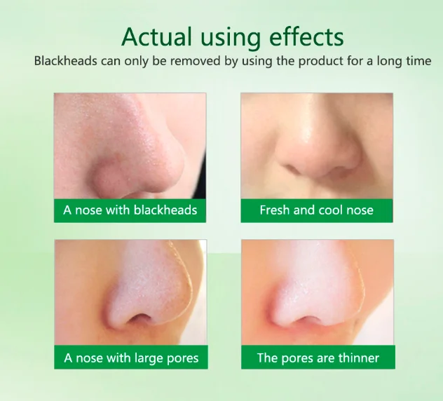 LANBENA Deep Blackhead смягчитель угрей экспорт жидкость для удаления угрей в носу лечение акне глубокое очищение кожи уход 20 мл