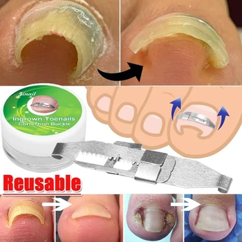 

Paronychia Ingrown toenails Adult Straightener Correction Tool Pedicure Foot Professional Health Care Nail Recover Tools