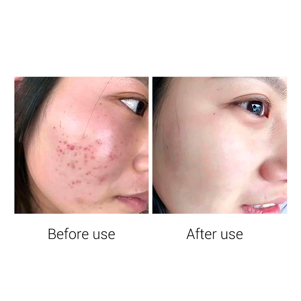 Kwadrant ritme Merg Breylee Acne Treatment Serum Face Sheet Mask Repair Anti Acne Scar Pimple  Removal Face Skin Care Whitening Facial Essence 1pcs - Masks - AliExpress