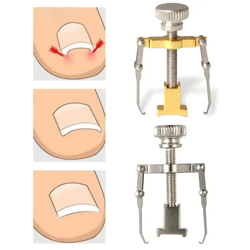 Metal Orthopedic Supplies Ingrown Toe Nail Recover Tool Foot Nail Corrector Toenail Fixer Pedicure Care Bunion Nail Pedicur U8J5