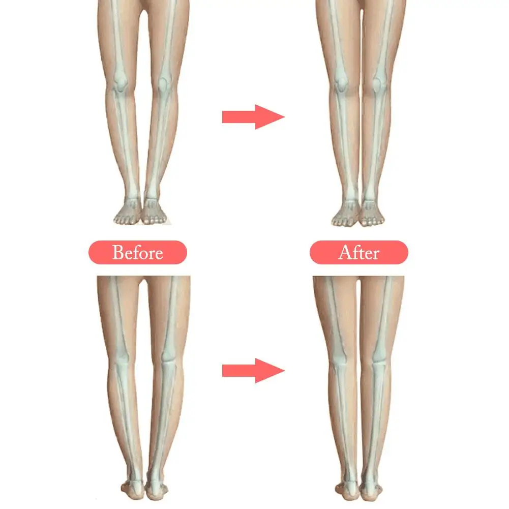 Эффективный O/X Тип ноги поклонились ноги колено Valgum выпрямление коррекции Группа Корректор осанки Красота Ноги пояс