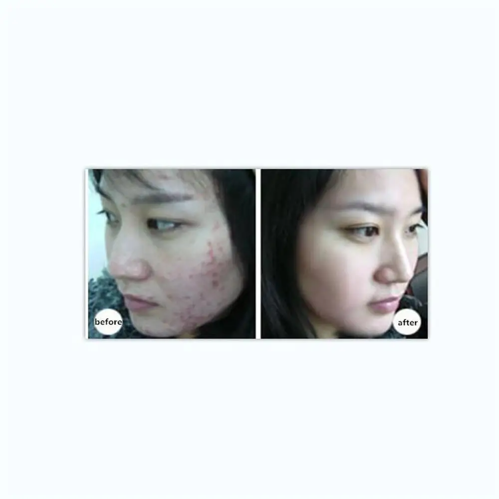 2 шт. уход за кожей 20% azelaic кислотный крем лечение акне против для удаления шрамов