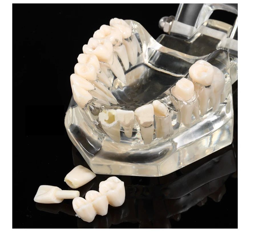 

Hot Sell Dental Implant Transparent Disease Removable Pathological Teeth Model