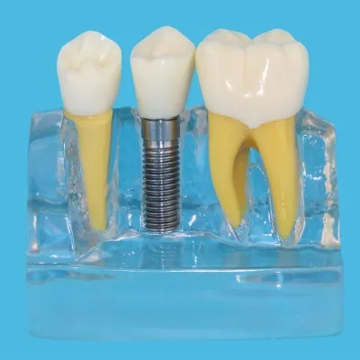 implanted teeth Demo Model Dentist doctor Patient communication free shipping