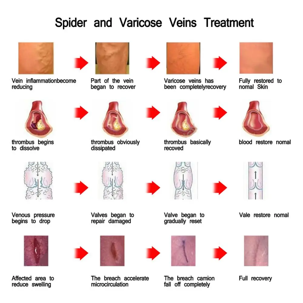Варикозные вены мазь Dredge кровеносные сосуды варикозный паук вены васкулит лечение продукт уход за кожей ног продукт