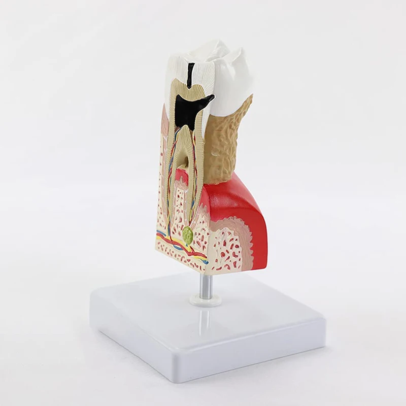 Tooth Pathological Disease Caries Medical Science Teaching Resources