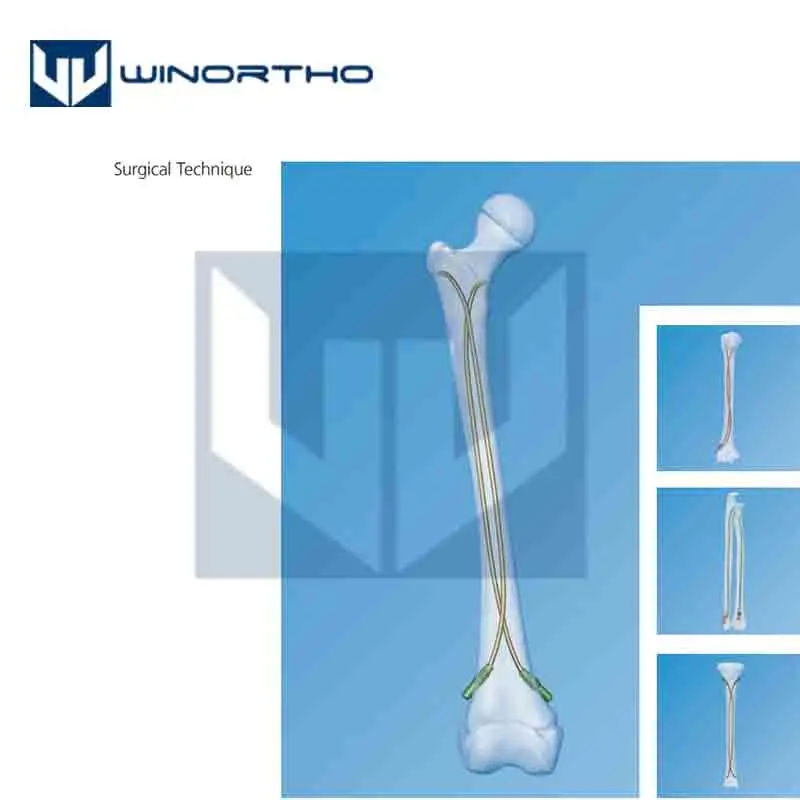 Functional Outcome in Clavicle Fractures Treated by Titanium Elastic Nail  System