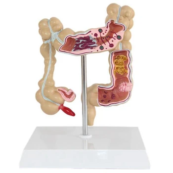 

Colorectal Lesion Model Human Colon Large Intestine Pathological Diseases Model Medical Mrganizer Anatomy