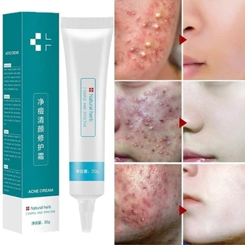 

20g Acne Treatment Blackhead Remove Anti Acne Cream Oil Control Shrink Pores Acne Scar Remove Face Care Whitening