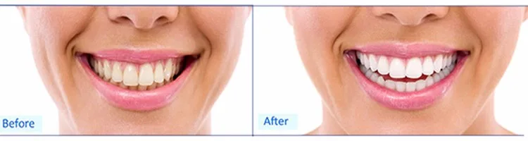 FDA&CE Approved Best No Sensitive Bleaching Gel Advanced Teeth Whitening Strips