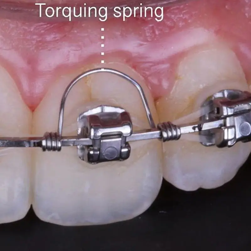 10Pcs/bag Orthodontic Torquing Spring Orthodontist Stainless Steel Single Anterior Teeth Torque Springs Rectangular | Красота и