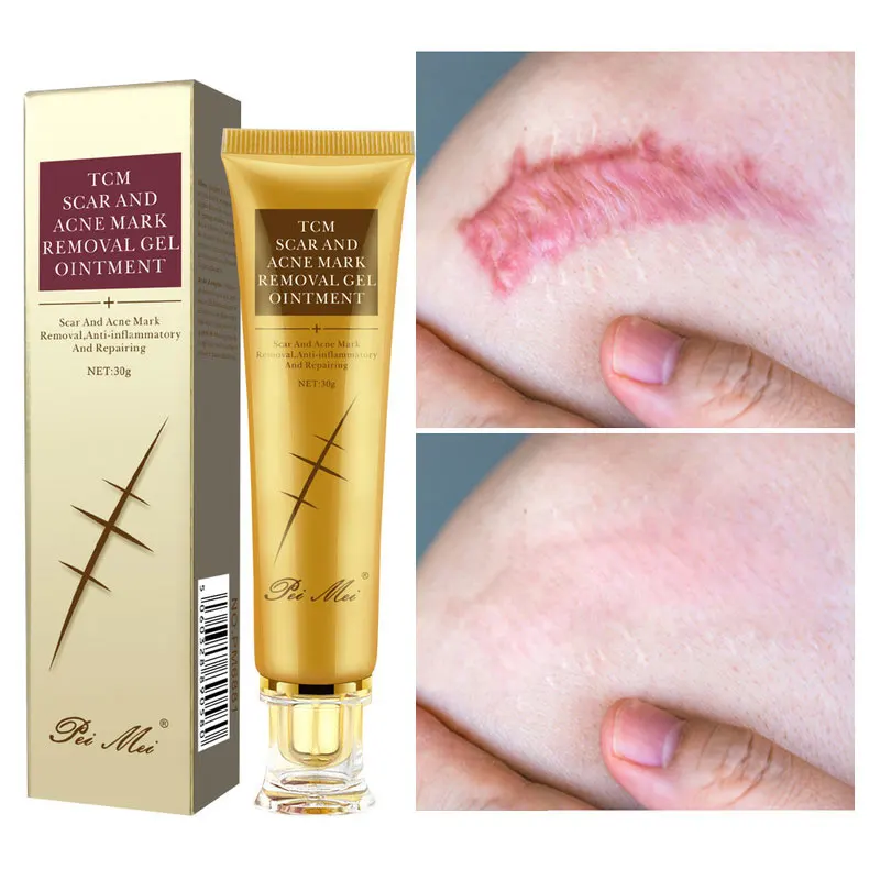 30g Acne Scar Removal Cream Pimples Stretch Marks Face Gel Remove Acne  Smoothing Whitening Moisturizing Body Skin Care - Day Creams  Moisturizers  - AliExpress