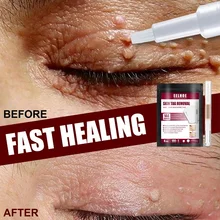 

Skin Tag Remover Patch Against Mole Genital Wart Within al Anti Foot Corn Fast Removal Warts Papillomas Medical Removes Moles