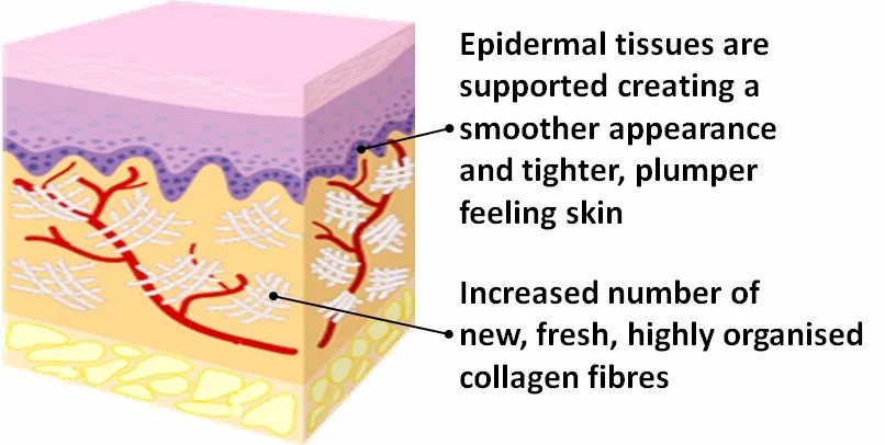 rf-skin-tightening-after