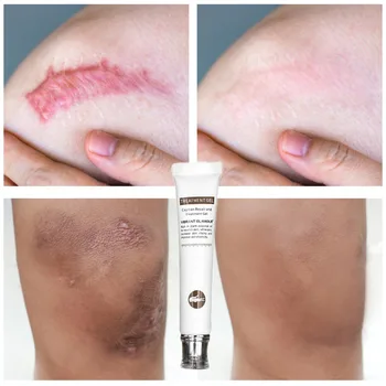 

VIBRANT GLAMOUR Crocodile Repair Scar Gel Removal Scar Acne Cream Treatment Marks For Face Body Pigmentation Corrector TSLM1