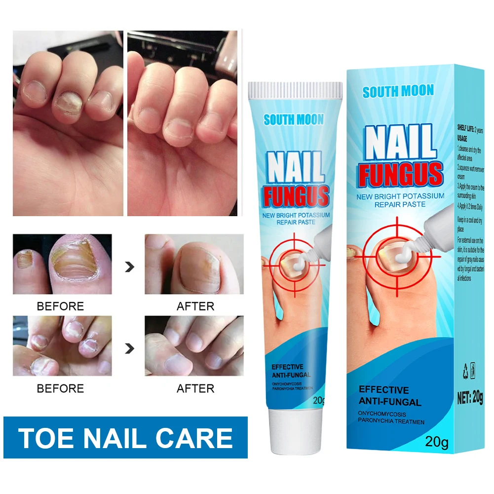 Nail Fungus Treatment Cream Fungal Nails Stop Ointment for Damaged