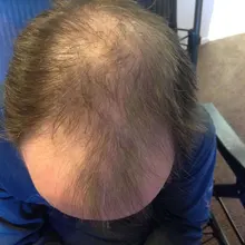 Cuidado del cabello para el crecimiento del cabello aceites esenciales esencia Original auténtico 100% pérdida de cabello líquido salud belleza suero denso para el crecimiento del cabello