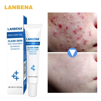 

LANBENA Anti Acne Moisturizing Gel cream Oil Control Shrink Pores oily skin Acne Spots Face skin care repairing Shrink Pores 20G