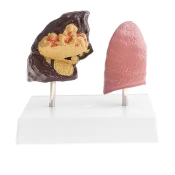 

1x Human Lung Normal Pathlogical Comparison Model Kits Lab Supplies