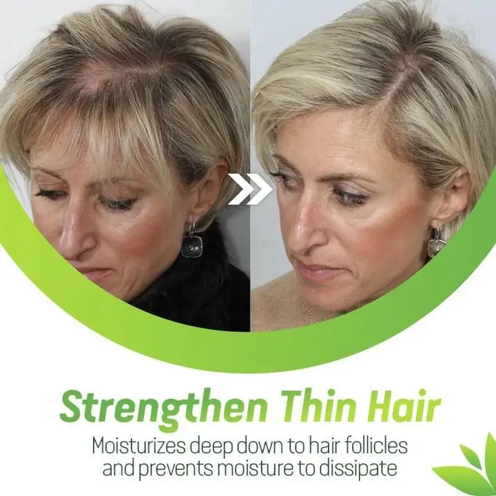 Rápido do Cabelo Perda de Cabelo Pces Crescimento Tratamento Anti Rápido Soro Gengibre Óleo Essencial 30ml 1 7x 1 cabelo tratamento anti perda de cabelo rápido