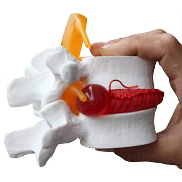 

1pc Anatomical Lumbar Disc Herniation Lumbar Spine Model White Color J99Store