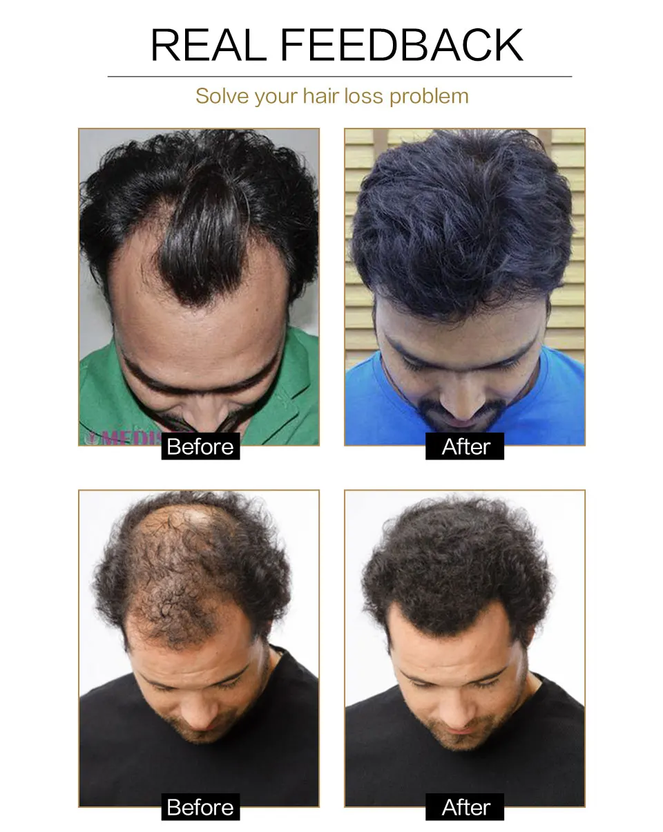 Óleo da Essência do Crescimento do Cabelo Tratamento da Perda de Cabelo para o Reparo do Óleo do Crescimento da Barba Raízes do Cabelo Produtos dos Cuidados com o Cabelo Anti Barba Dano Tônico da 14 Cheap Prod. perda cab. masc.