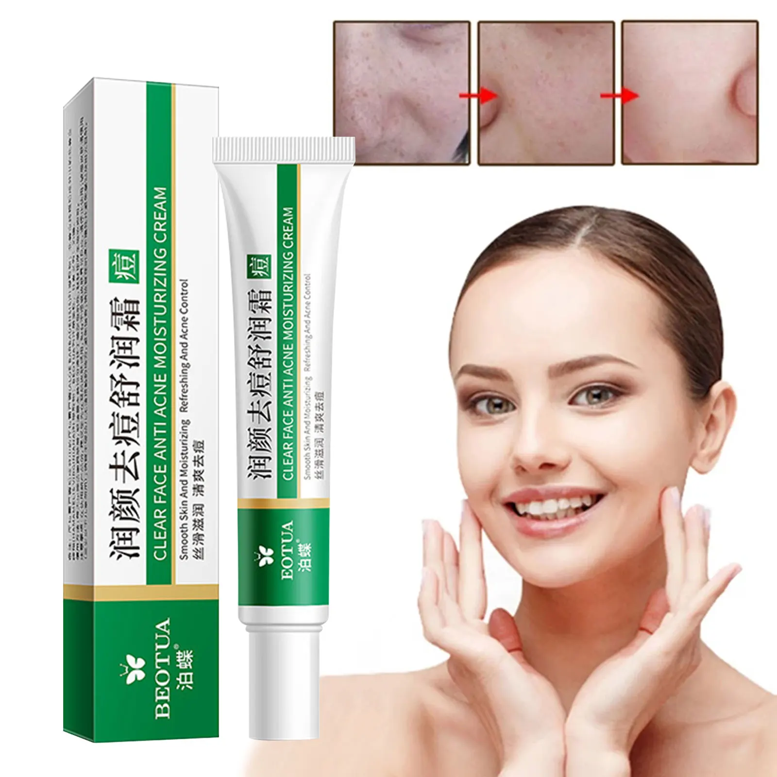 Effective Acne Removal Cream Acne Treatment Fade Acne Spots Oil Control