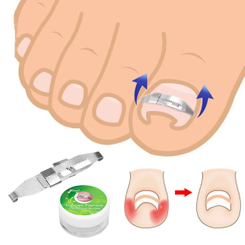 High Quality Ingrown Toe Nail Correction Wire Fixer Pedicure Paronychia Recover Toenails Corrector Foot Care Tool