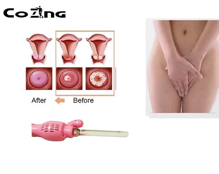 COZING светодиодный терапевтический прибор красного света для Cervicitis