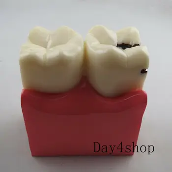 

Caries Teeth Comparation Model Dental Study Education Demonstration