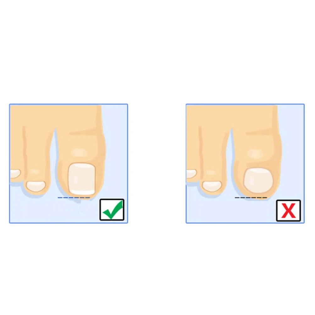 1Pc Ingrown Toe Nail Patch Sticker Acronyx Foot File Care Tool Correction Paronychia Wire Corrector NEW