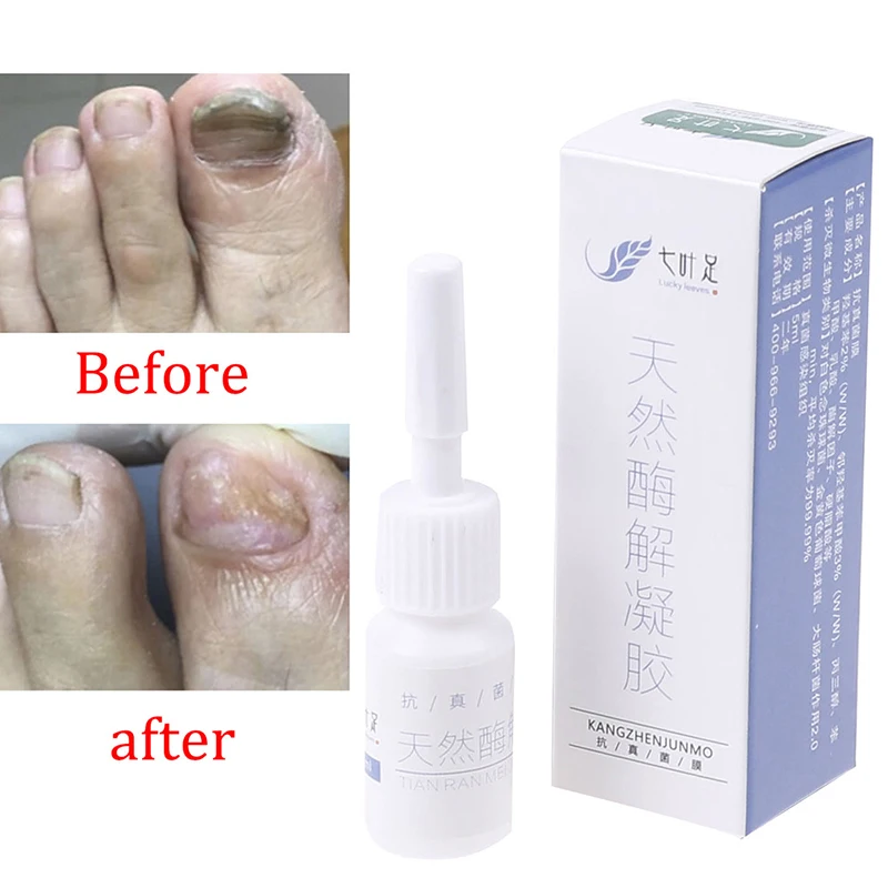 1pc Nail Repair Treatment Gel Antibacterial Onychomycosis Remover Serum Disinfect Fingernails Toenails Care
