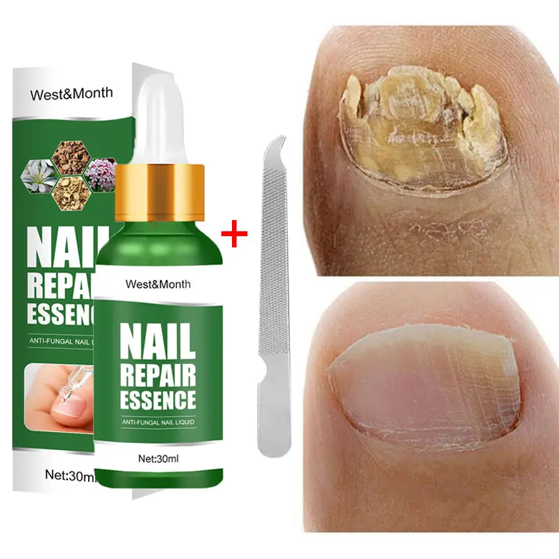 Сыворотка для лечения Ногтей от грибков эссенция восстановления ног паронихии