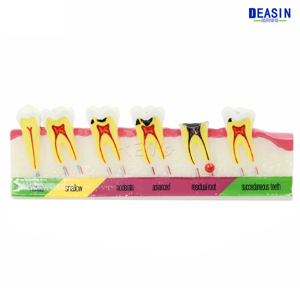 

High Quality Dental Caries Developing illusteation Tooth Model Demonstration Teach Patient
