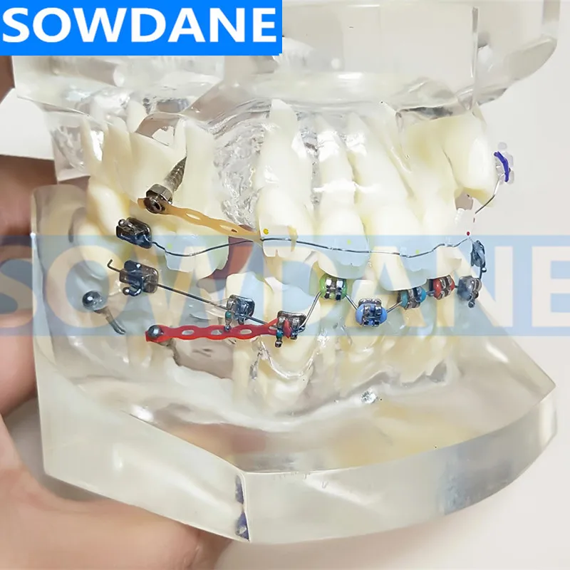Transparent Dental Orthodontic Mallocclusion Model with two kinds of