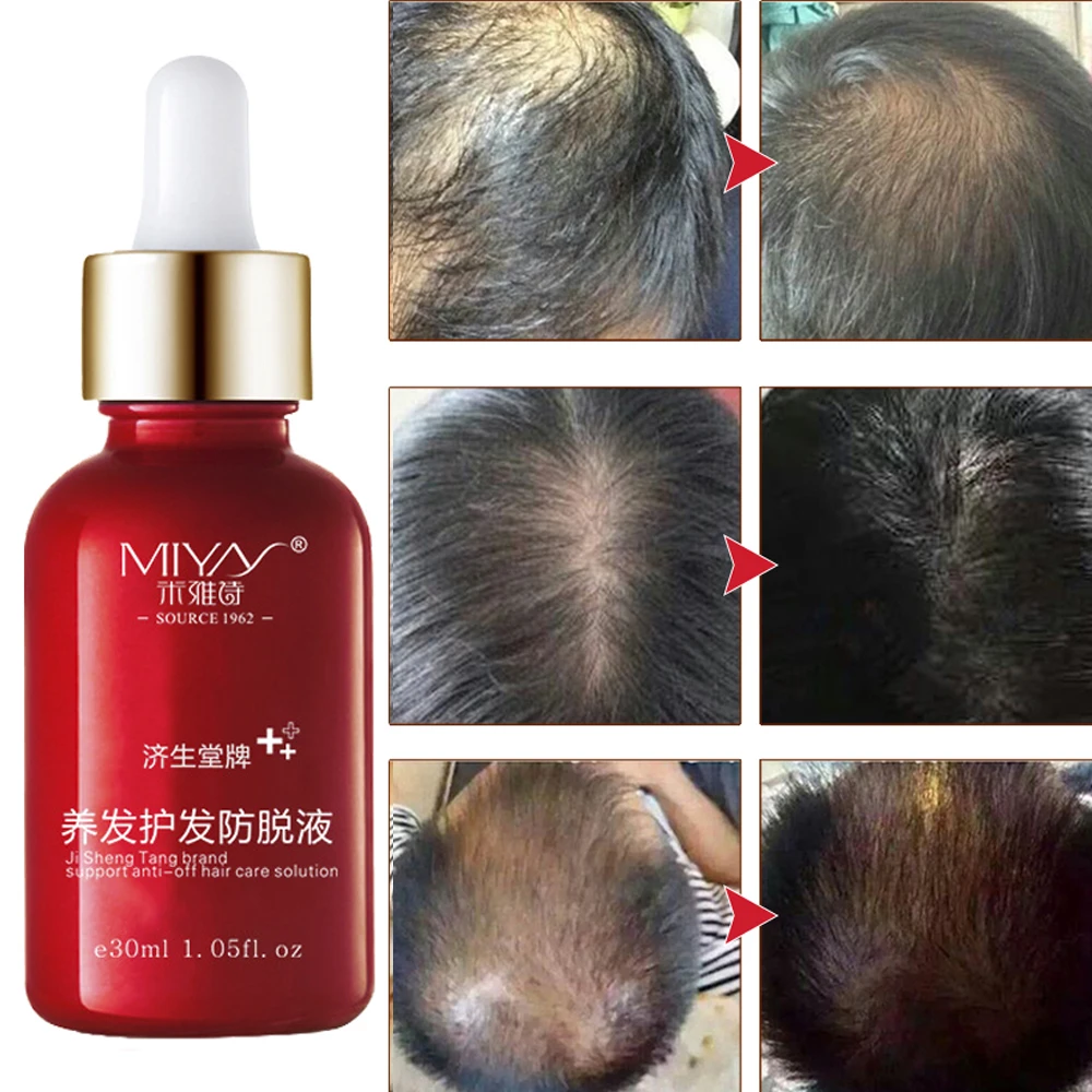 Aceite para el cuidado del cabello para hombres y mujeres, productos para el crecimiento del cabello, esencia de rebrote, tratamiento líquido para prevenir la pérdida de cabello