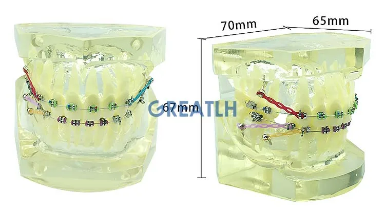 dentes ortodônticos dentários modelo transparente modelo ortodôntico com suportes