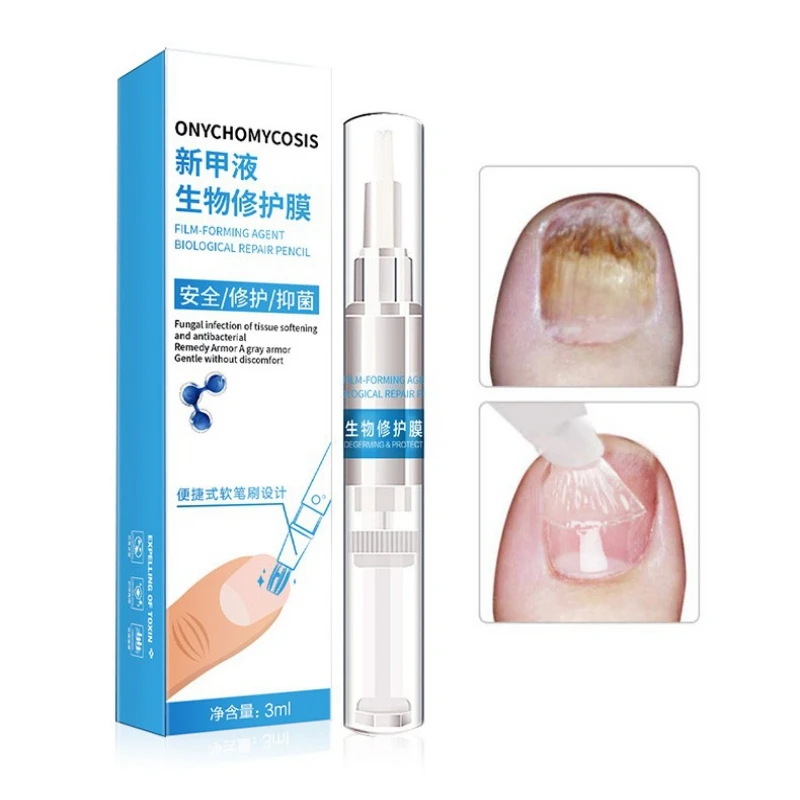 Nail Treatment Pen Quickly Eliminate Nail Fungus Speed Up Nail Growth Nail Treatment Liquid