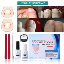 1 Набор, корректор парониксии, коррекция вросших пальцев ног, уход за ногами, фиксатор для педикюра, пароникция, восстановление макияжа, инструмент TSLM2