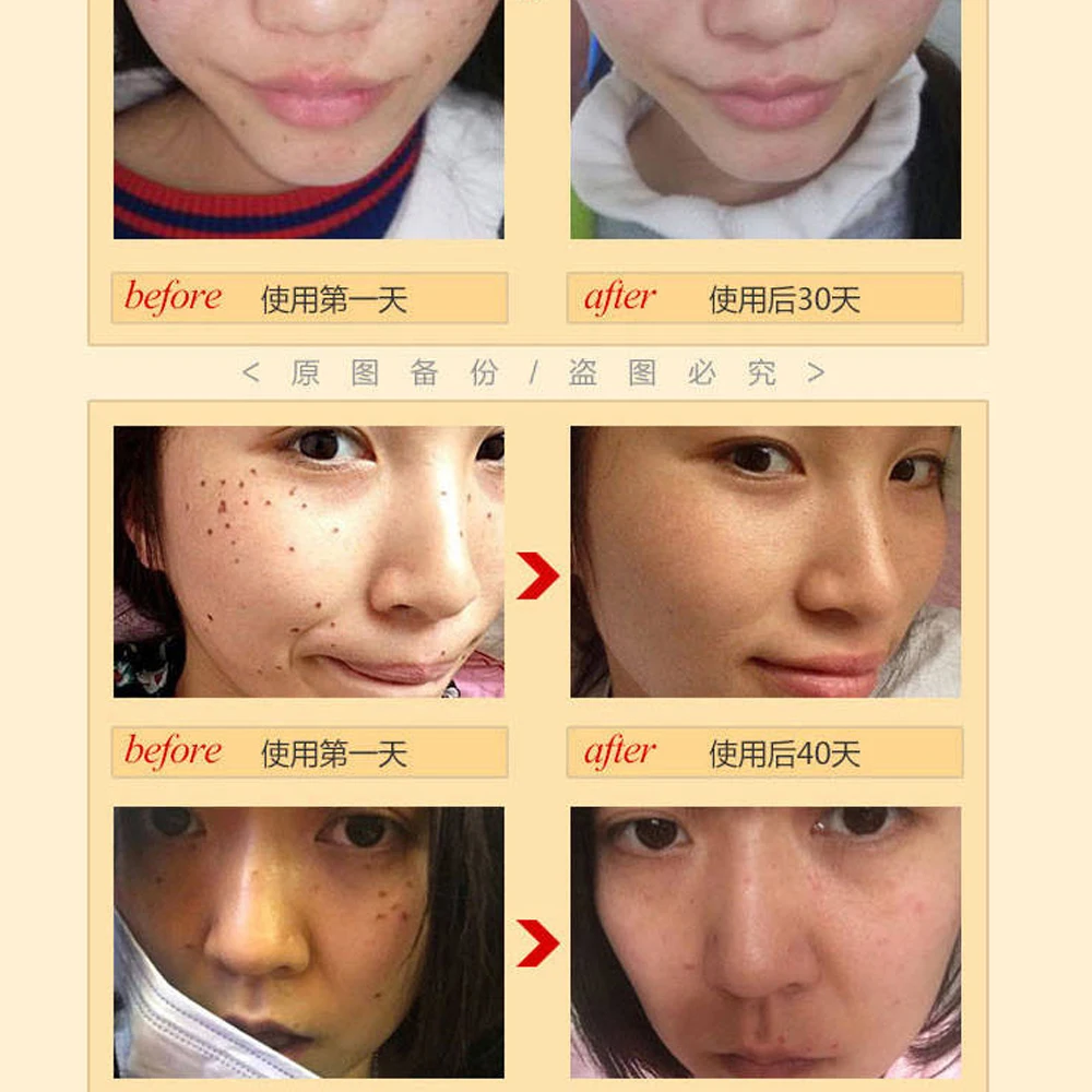 20ml Face Dark Spot Repair Mole& Skin Tag Repair Solution Painless Mole Skin Face Wart Tag Freckle Repair Cream Oil