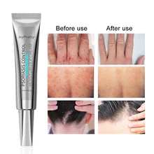 

20g Psoriasis Cream Natural Anti-Itching Ointment Fungal Treatment for Dermatitis Eczema Dry Cracked Moisturize Cream Skin Care