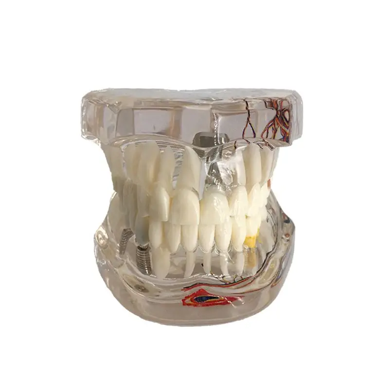 Прямая поставка Стоматологическая модель зубного имплантата с реставрационным мостом зубной Стоматолог для медицинских исследований