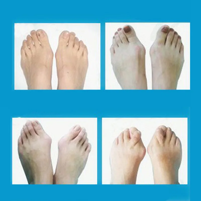 OPHAX 2 шт./1 пара Силиконовый гель Bunion шина сепаратор для большого пальца ноги перекрывающий Рассекатель костной защиты корректор стопы поддерживает уход